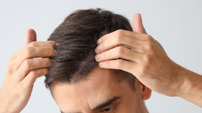 Dandruff: Causes, Types, and Treatments